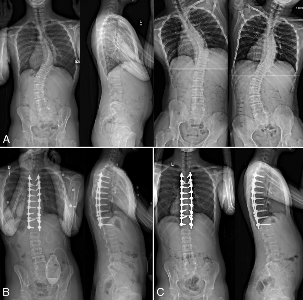 Escoliose Dr Vagner De Paiva Ortopedista