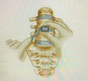 dr-vagner-de-paiva-ortopedista-da-coluna-vertebral-alif-fusao-lombar-anterior