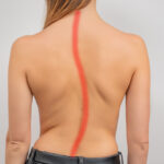Woman with scoliosis of the spine. Curved woman’s back.